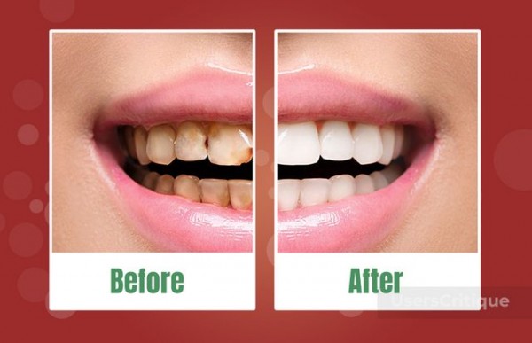 Advantages of Using the Prodentim Best Dental Supplement?