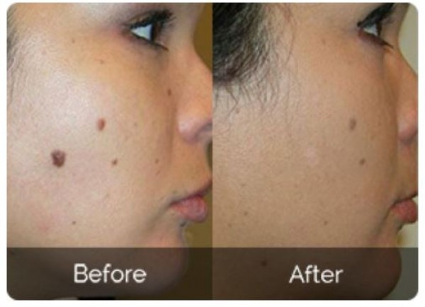  Amarose Skin Tag Remover Reviews | Cost, Side, Effects, Ingredients, Official Website