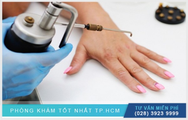 Áp lạnh điều trị mụn cóc 