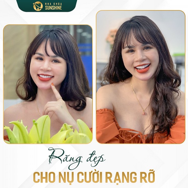 Bảng giá bọc răng sứ ở Hải Dương