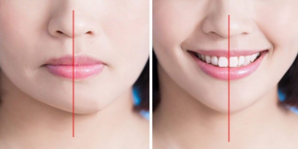 Bật mí cách cười cho răng hô trở nên duyên dáng