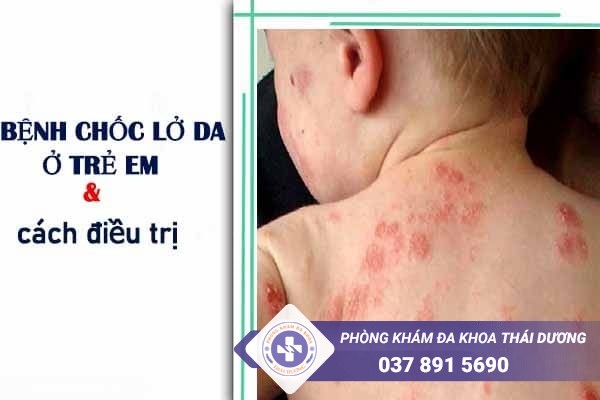 Bệnh chốc lở da ở trẻ em và cách điều trị hiệu quả