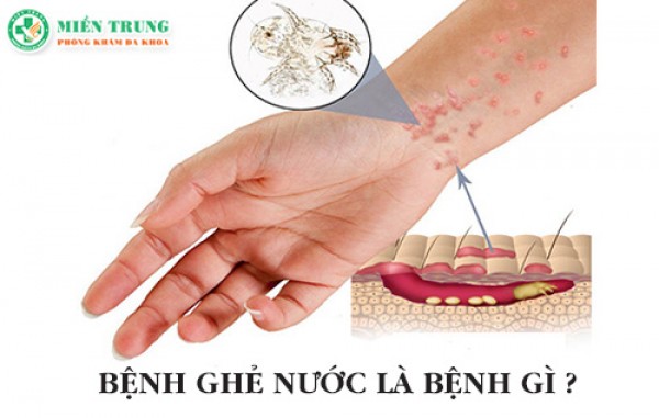 Bệnh ghẻ nước và phương pháp điều trị 