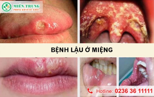 Bệnh lậu ở miệng 