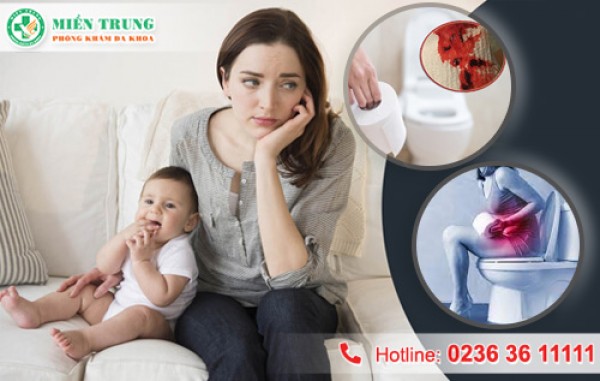 Bệnh trĩ ở phụ nữ sau sinh 