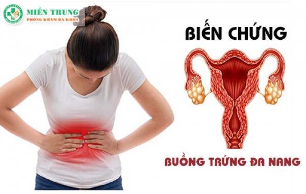 Biến chứng nguy hiểm của buồng trứng đa nang 