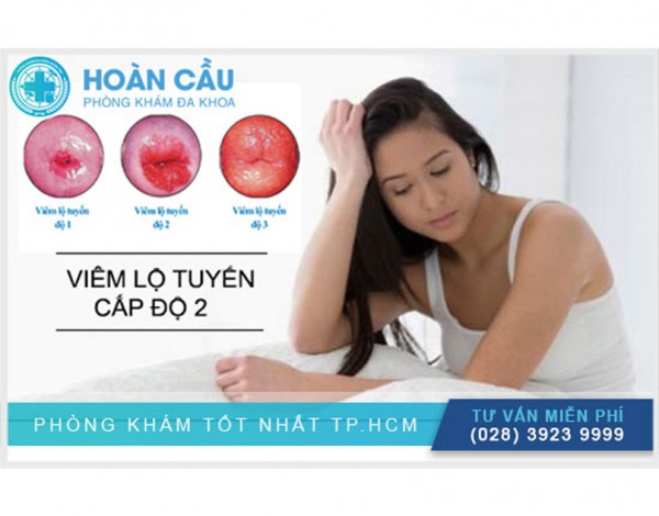 Biểu hiện và cách điều trị viêm lộ tuyến cổ tử cung độ 2