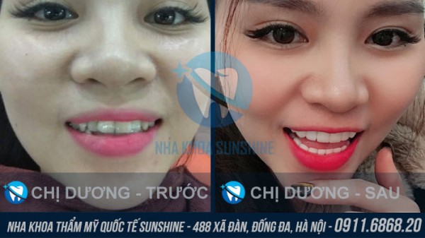 Bọc răng sứ bị cộm không?