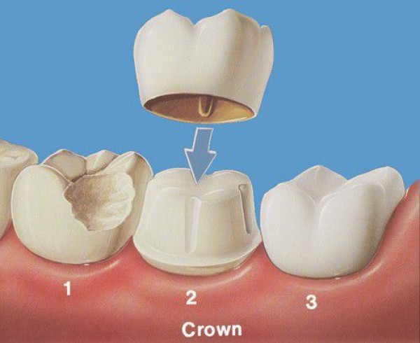 Bọc răng sứ cho răng sâu bao nhiêu tiền?