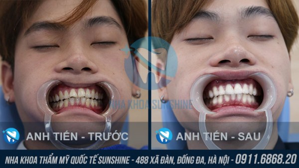 Bọc răng sứ không kim loại giá bao nhiêu hiện nay?