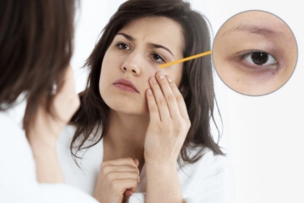 Các biến chứng có thể có sau khi cắt mí mắt không an toàn