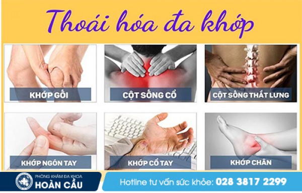 Cách điều trị thoái hóa đa khớp - Đa khoa Hoàn Cầu 