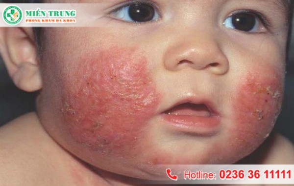 Cách điều trị viêm da cơ địa ở trẻ em 