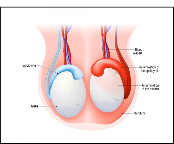 Cách giảm đau tức tinh hoàn