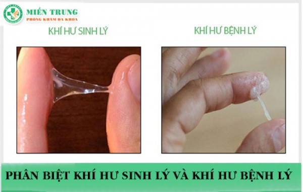 Cách phân biệt khí hư sinh lý và khí hư bệnh lý 