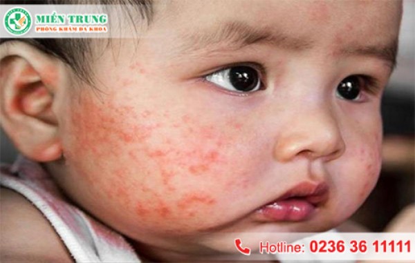 Chàm ở trẻ nhỏ 