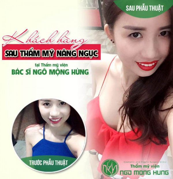 Chi phí phẫu thuật lõm ngực