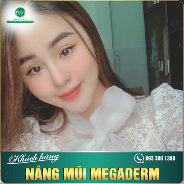 Chỉnh nâng mũi hết bao nhiêu tiền?