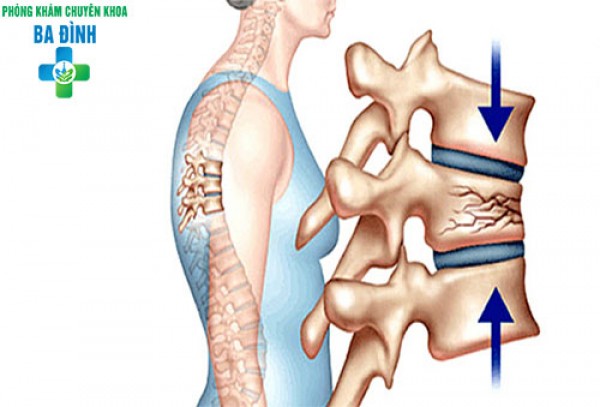 Chữa xẹp đốt sống D12 tại chuyên khoa xương khớp Ba Đình