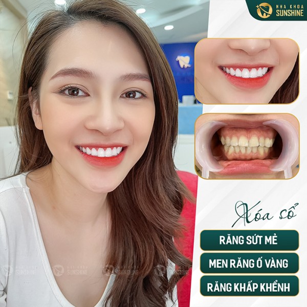 Có nên dán sứ veneer giá rẻ