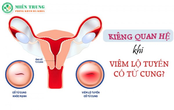 Có nên kiêng quan hệ khi viêm lộ tuyến cổ tử cung 