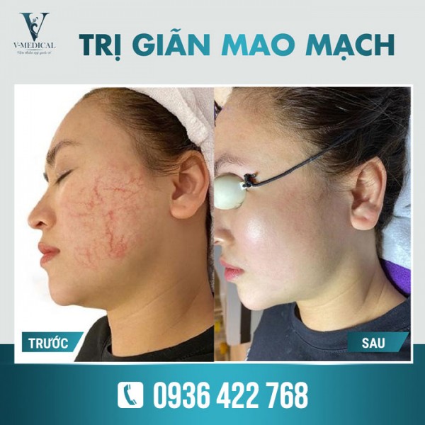 Công nghệ điều trị giãn mao mạch