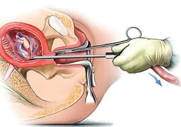 [CUỘC SỐNG 24H] Phá thai 13 tuần tuổi có nguy hiểm không năm 2021