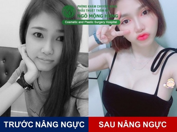 Đặt túi nâng ngực giá bao nhiêu tiền