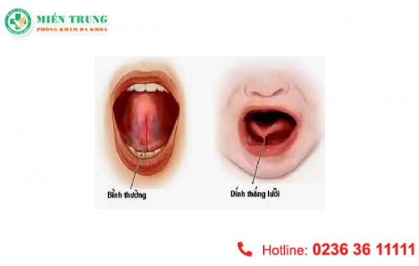 Dấu hiệu dính thắng lưỡi ở trẻ 