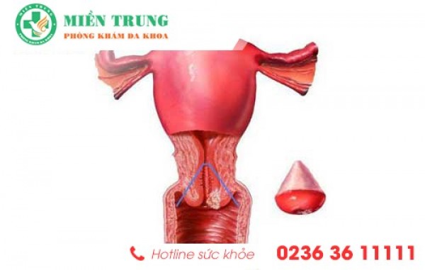 Dấu hiệu nhận biết bệnh phì đại cổ tử cung 