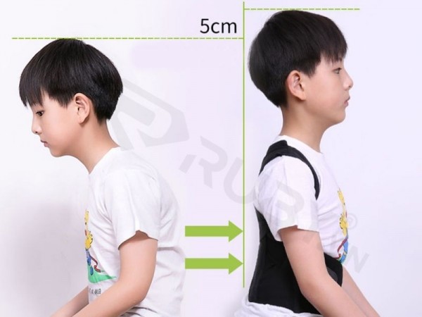 Dấu hiệu nhận biết gù lưng ở trẻ nhỏ và hướng điều trị kịp thời