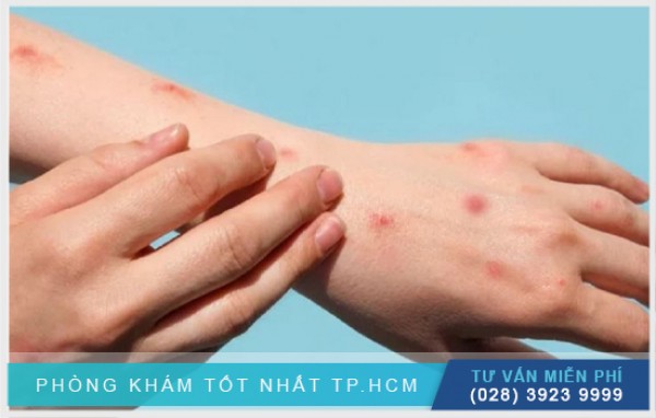 Đậu mùa khỉ có lây qua đường tình dục