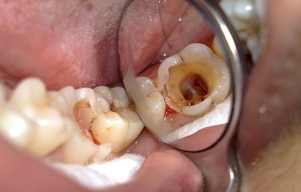 Đau nhức răng hàm dưới phải làm thế nào?