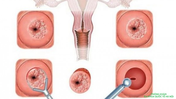 Dịch phụ khám chữa bệnh cổ tử cung tại hà nội