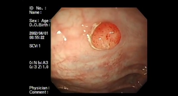 Hình ảnh về video cắt polyp cổ tử cung