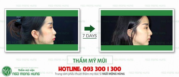 Kẹp nâng mũi facebook có thật sự chất lượng không?