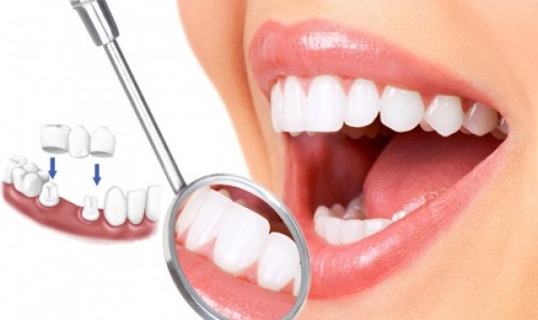 Làm cầu răng sứ giá bao nhiêu ở hà nội?
