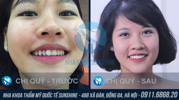 Làm cầu răng sứ giá bao nhiêu ở Hà Nội