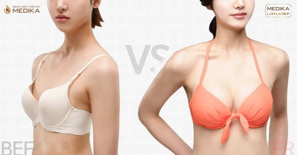 Làm nghề phẫu thuật nâng ngực thẩm mỹ dư hay thiếu việc làm?