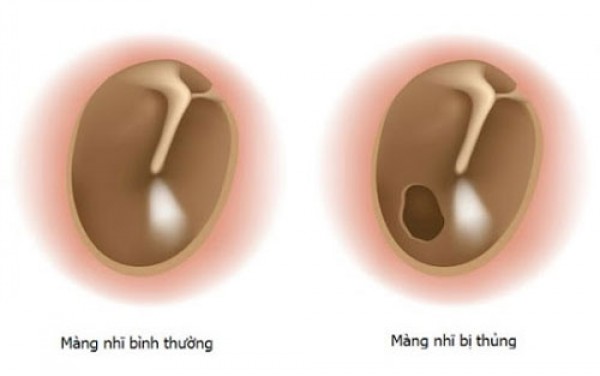 Lỗ tai bị chảy máu bất thường là bị gì? Cách chữa trị?