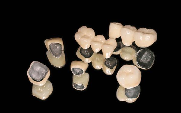 Lợi ích của răng sứ Titan trong việc tái tạo vẻ đẹp cho nụ cười
