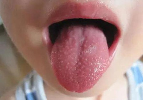 Lưỡi nổi mụn thịt không đau là bị gì? Cách chữa trị tại nhà