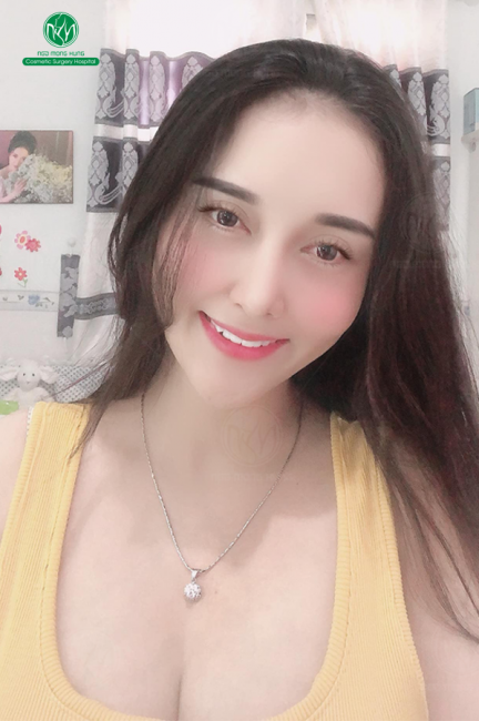 Lưu ý khi nâng ngực trả góp