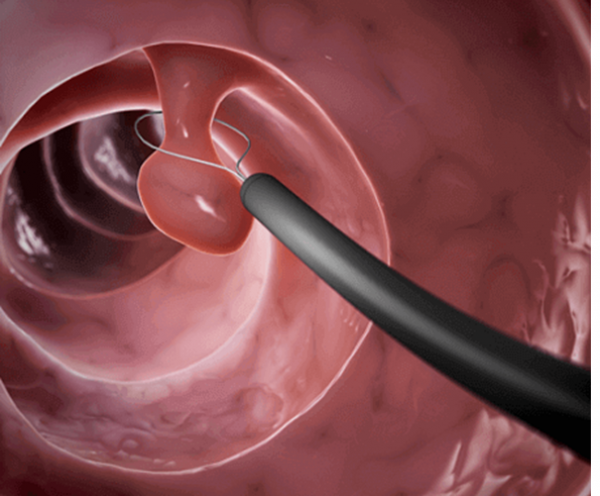 Mổ polyp cổ tử cung thì bao lâu mang thai được