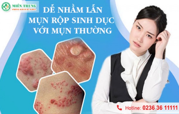 Mụn rộp sinh dục dễ nhầm lẫn với mụn thường 