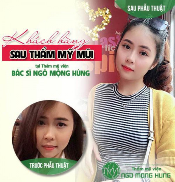 Nâng mũi bao lâu thì lành webtretho