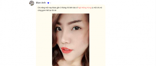 Nâng mũi có đau không tại BVTMNMH