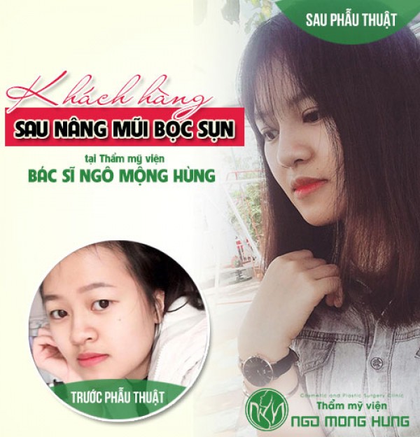 Nâng mũi không phẫu thuật giữ được bao lâu