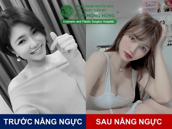 Nâng ngực đẹp ở đâu tại TP HCM