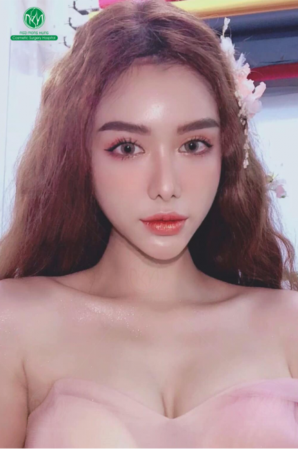 Nâng ngực giá bao nhiêu